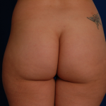 Brazilian Butt Lifts (BBL) Before & After Patient #786