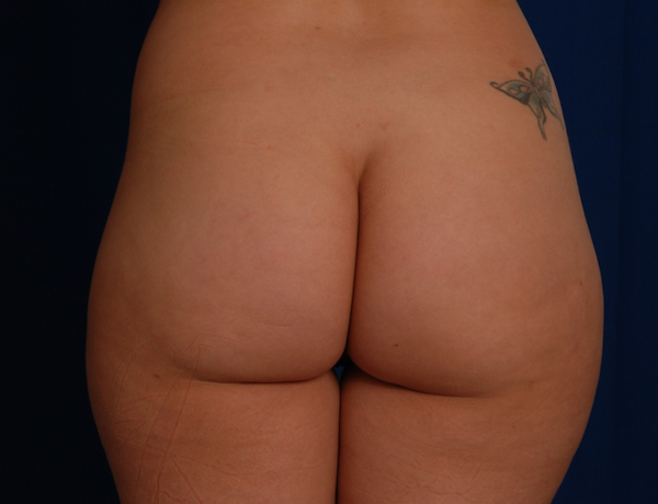 Brazilian Butt Lifts (Women BBL) Before & After Patient #786