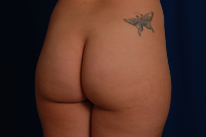 Brazilian Butt Lifts (BBL) Before & After Patient #786