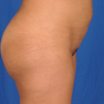 Brazilian Butt Lifts (BBL) Before & After Patient #797