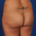 Brazilian Butt Lifts (BBL) Before & After Patient #797