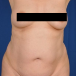 Tummy Tuck Before & After Patient #807