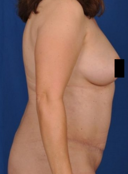 Tummy Tuck Before & After Patient #807