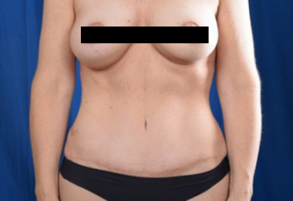 Tummy Tuck Before & After Patient #812