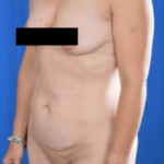 Tummy Tuck Before & After Patient #812