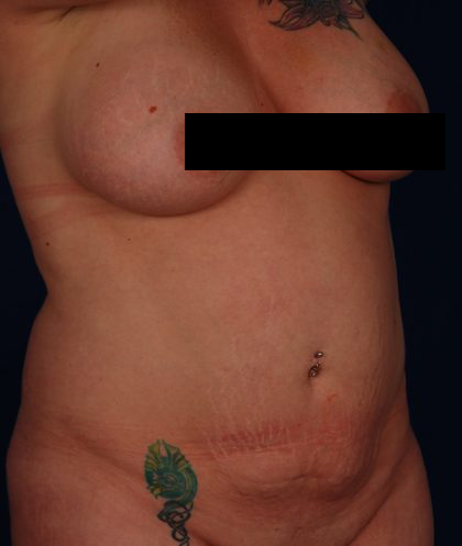 Tummy Tuck Before & After Patient #820