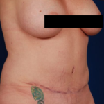 Tummy Tuck Before & After Patient #820