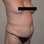 Torso Liposuction Before & After Patient #873