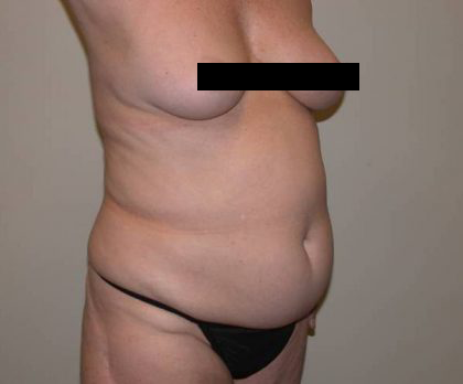 Torso Liposuction Before & After Patient #873