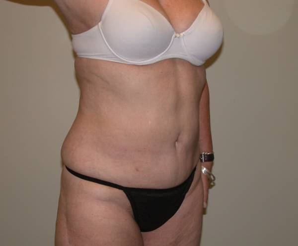 Torso Liposuction Before & After Patient #873