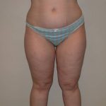 Legs Liposuction Before & After Patient #881