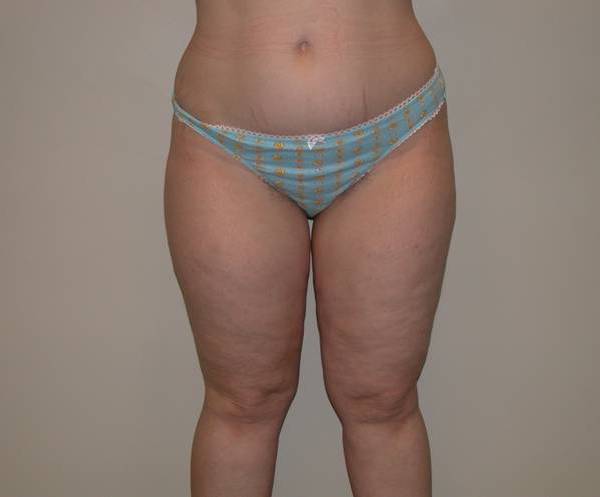 Legs Liposuction Before & After Patient #881