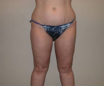 Legs Liposuction Before & After Patient #881