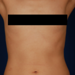 Torso Liposuction Before & After Patient #890