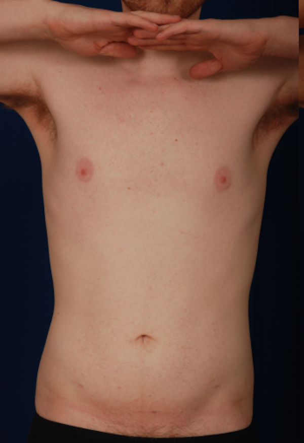 Torso Liposuction Before & After Patient #893