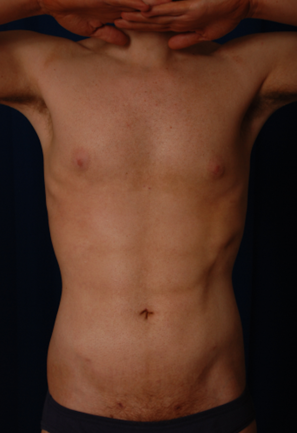 Torso Liposuction Before & After Patient #893
