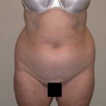Torso Liposuction Before & After Patient #896