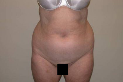 Torso Liposuction Before & After Patient #896