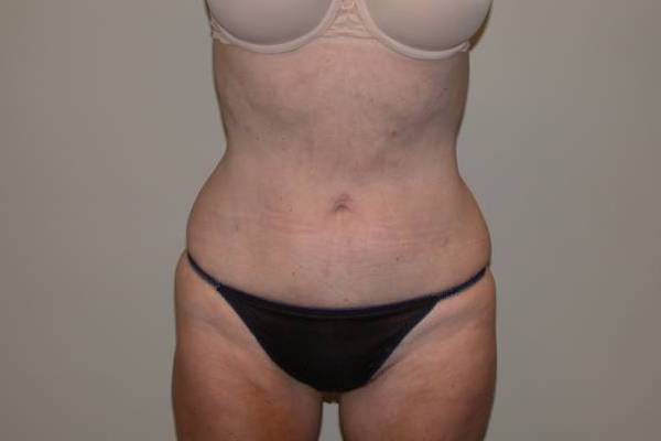 Torso Liposuction Before & After Patient #896