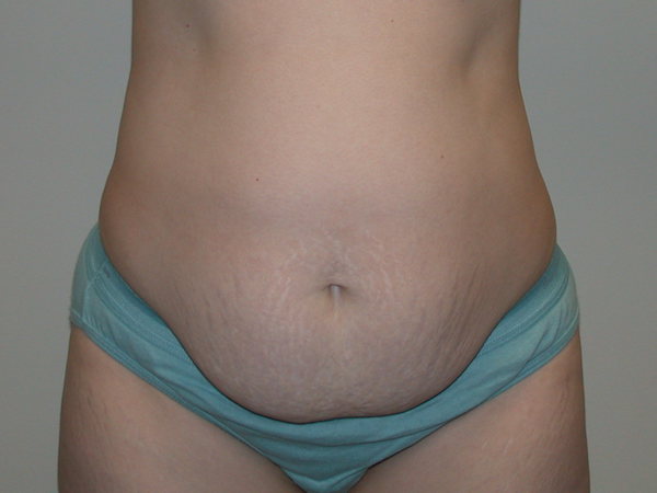 Tummy Tuck Before & After Patient #856