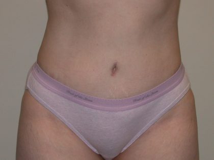 Tummy Tuck Before & After Patient #856