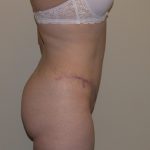 Tummy Tuck Before & After Patient #856