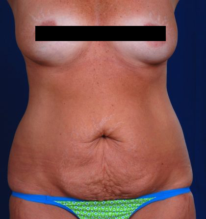Tummy Tuck Before & After Patient #819