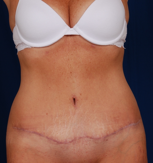 Tummy Tuck Before & After Patient #819