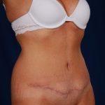 Tummy Tuck Before & After Patient #819