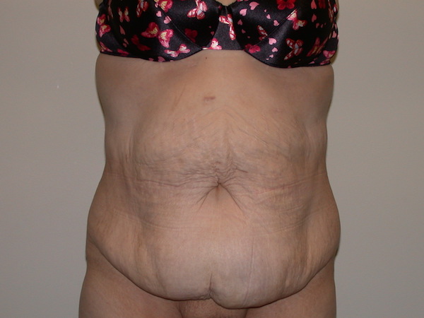 Tummy Tuck Before & After Patient #829