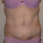 Tummy Tuck Before & After Patient #829