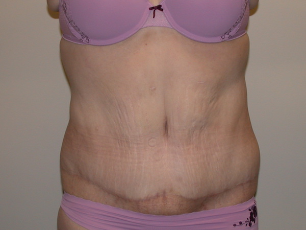 Tummy Tuck Before & After Patient #829