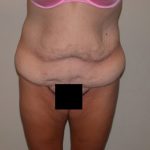 Tummy Tuck Before & After Patient #830