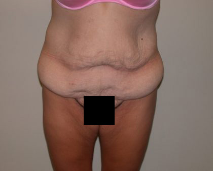 Tummy Tuck Before & After Patient #830