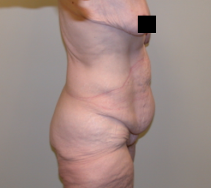 Tummy Tuck Before & After Patient #835