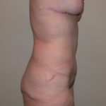 Tummy Tuck Before & After Patient #835