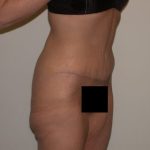 Tummy Tuck Before & After Patient #836