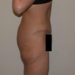 Tummy Tuck Before & After Patient #836