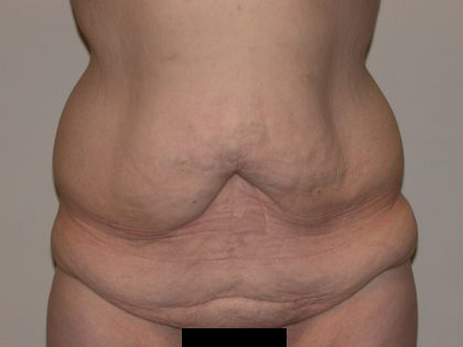 Tummy Tuck Before & After Patient #848