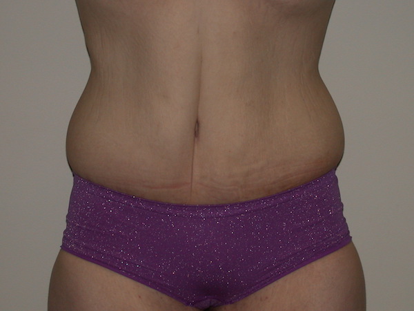 Tummy Tuck Before & After Patient #848