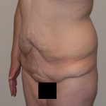 Tummy Tuck Before & After Patient #848
