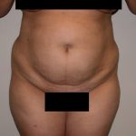 Tummy Tuck Before & After Patient #855