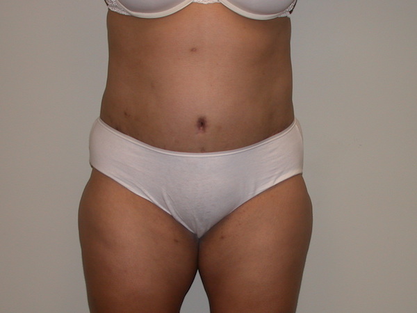 Tummy Tuck Before & After Patient #855