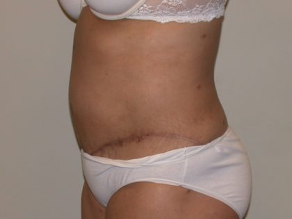 Tummy Tuck Before & After Patient #855