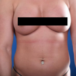 Torso Liposuction Before & After Patient #953