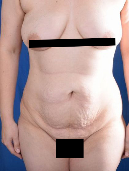 Tummy Tuck Before & After Patient #968