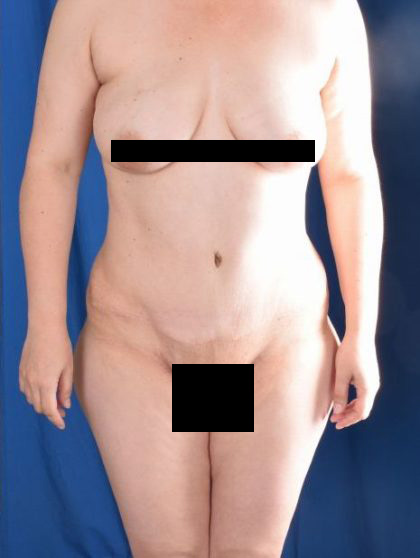 Tummy Tuck Before & After Patient #968