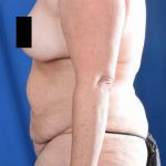 Tummy Tuck Before & After Patient #976