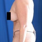 Tummy Tuck Before & After Patient #976