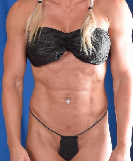 Torso Liposuction Before & After Patient #953